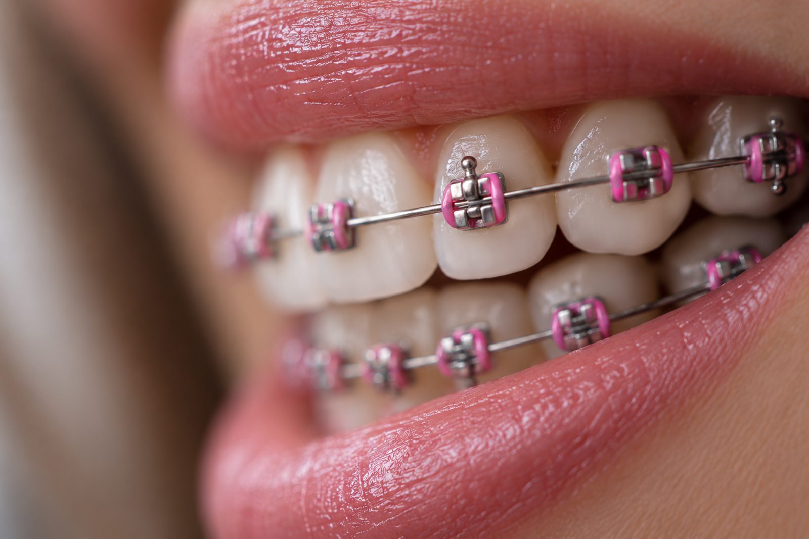 Brackets metálicos con cauchitos de colores sobre los dientes superiores e inferiores