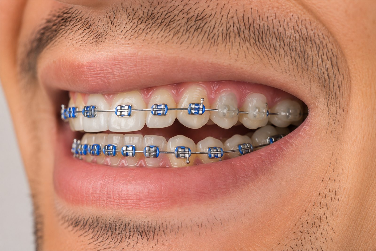 Brackets metálicos sobre los dientes, en el borde donde la cera alivia el roce