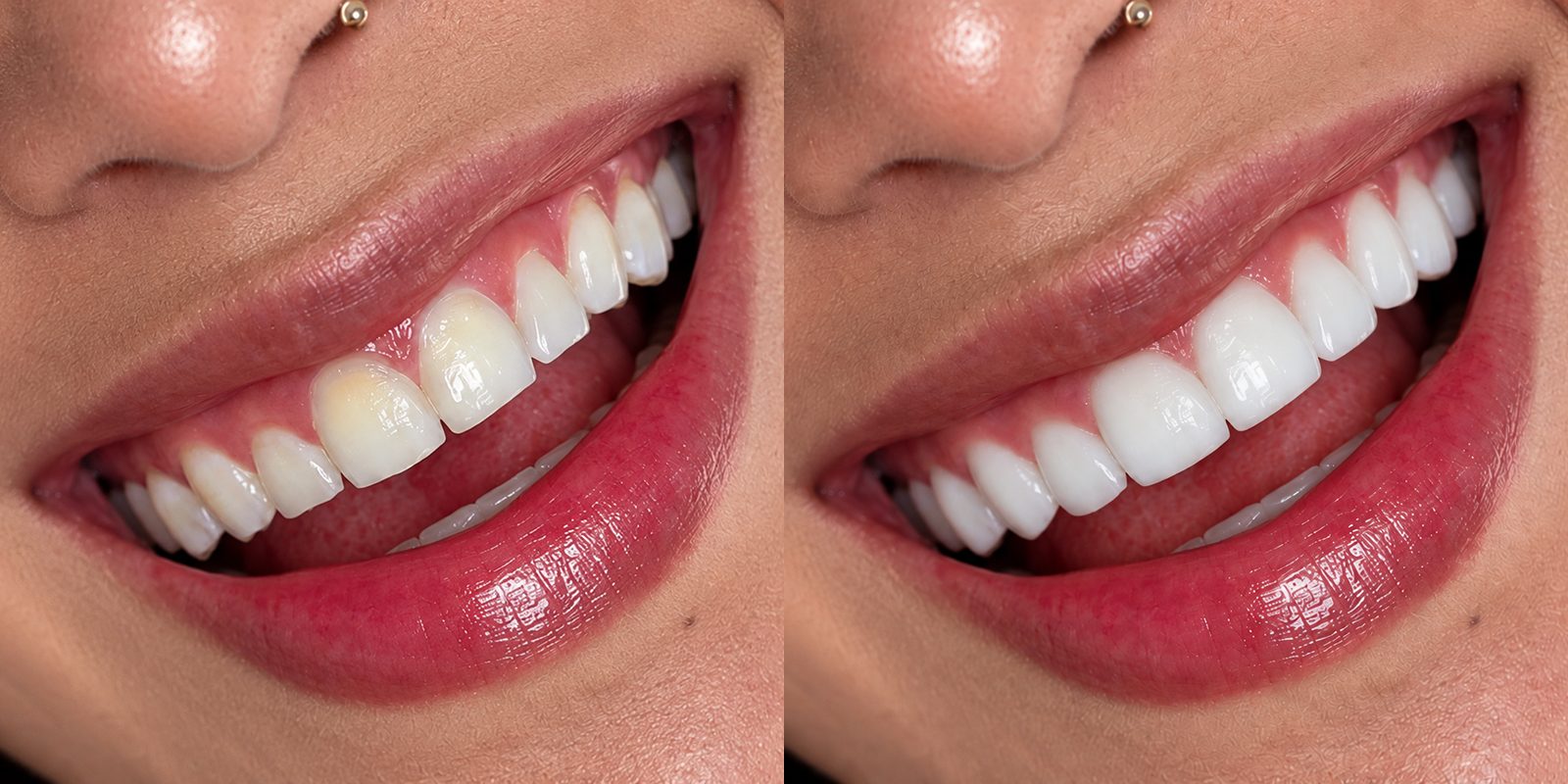 Antes y después de un diseño de sonrisa sobre la misma boca