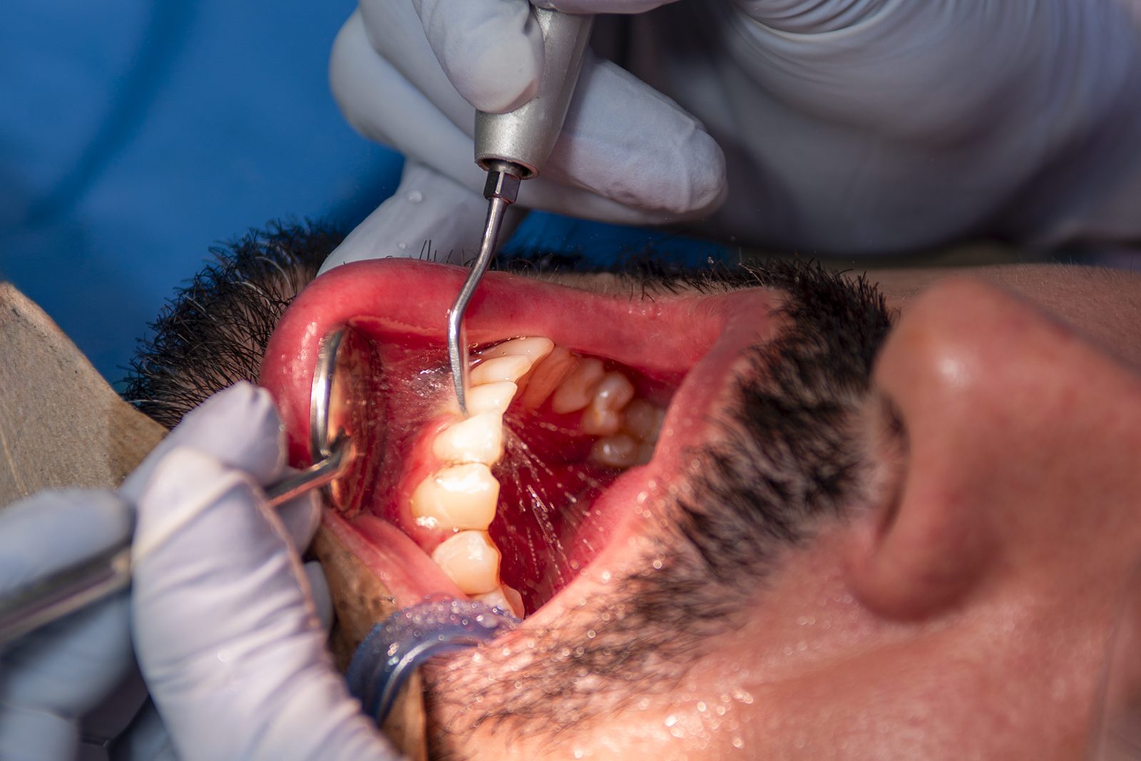 Punta de ultrasonido retirando cálculo de los dientes durante una limpieza