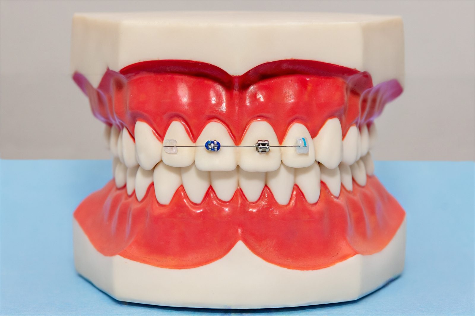 Modelo dental con brackets cementados y el arco pasando por las ranuras